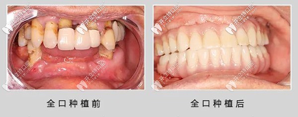 69歲退伍老兵做了ALL- on-6全口種植牙，感言：再活30年！