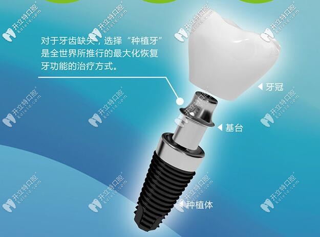 種植牙介紹
