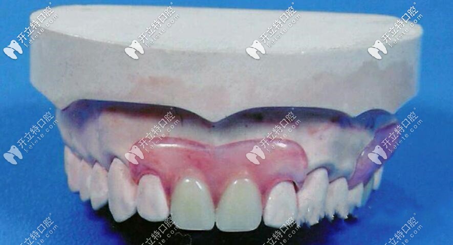 我老爸當(dāng)初用的就是類(lèi)似下邊的這個(gè)義齒