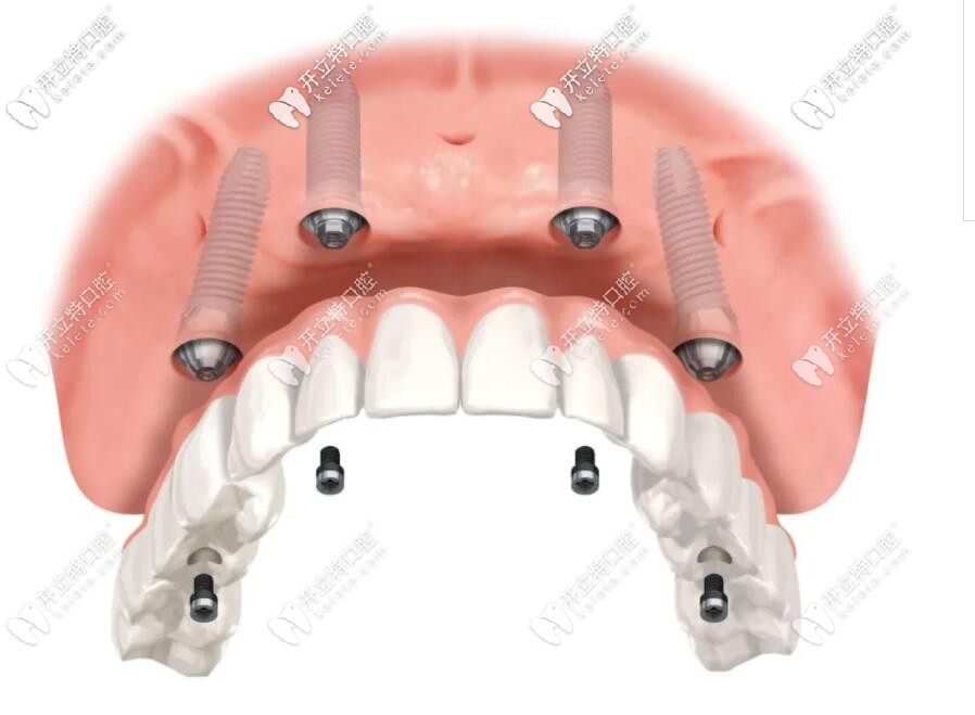 allon4種植半口牙的示意圖