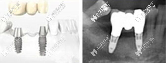 這是一個(gè)缺三顆牙種2顆植體的案例圖