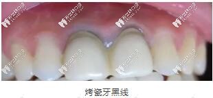 牙齦黑線