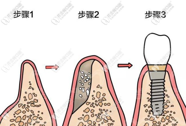 種牙在什么情況下需要植骨