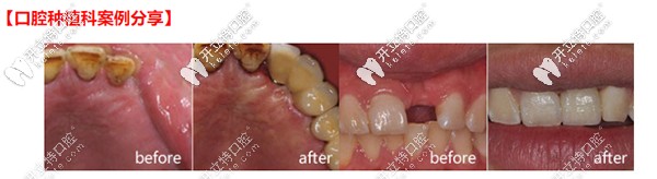 尚愛韓美口腔種植牙案例