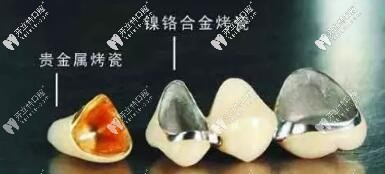 貴金屬烤瓷牙與鎳鉻合金烤瓷牙的區(qū)別