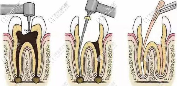 補牙打樁好還是不打樁好