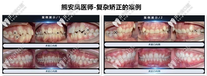 熊安鳳-復雜正畸案例分享
