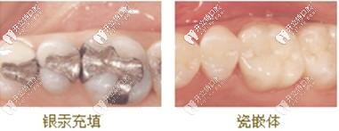 傳統(tǒng)補(bǔ)牙和嵌體補(bǔ)牙圖片