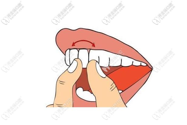 松牙固定術(shù)一般固定多久