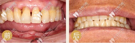 種牙前后對(duì)比