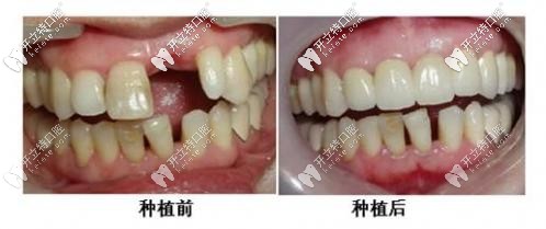種牙前后對比