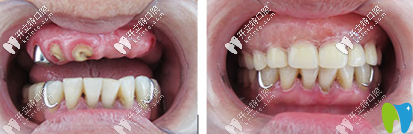 黃宏院長種植案例