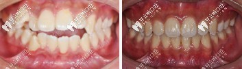 矯正牙齒前后對(duì)比