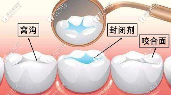 北京圣貝海淀牙科解鎖兒童六齡齒窩溝封閉有必要做嗎？