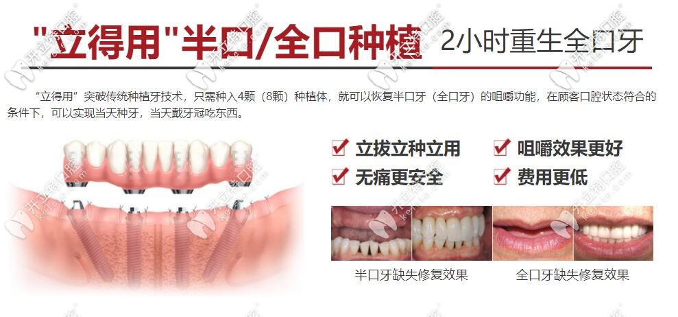 半口/全口種植牙技術(shù)介紹