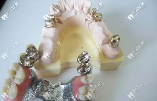 套筒冠義齒修復(fù)示意圖