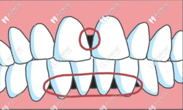 牙齒二級松動黑三角