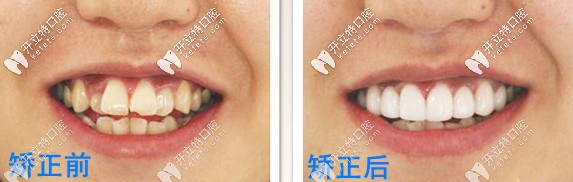 矯正前后對(duì)比