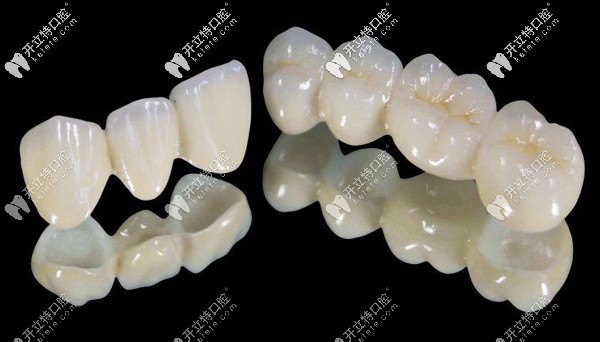 樂瓷全瓷牙價格是多少，怎么辨別德國樂瓷牙冠真假呢？