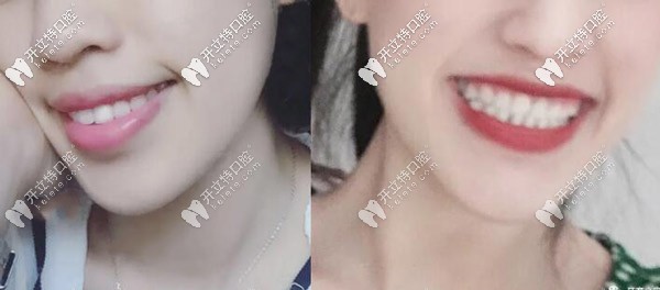 矯正前后的變化