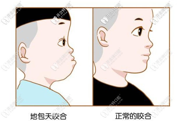 牙齒地包天有必要治嗎？哪個年齡階段矯正比較好