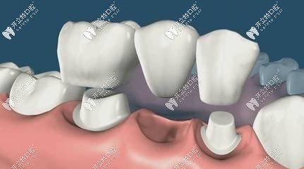 牙根壞死，做的烤瓷牙固定修復