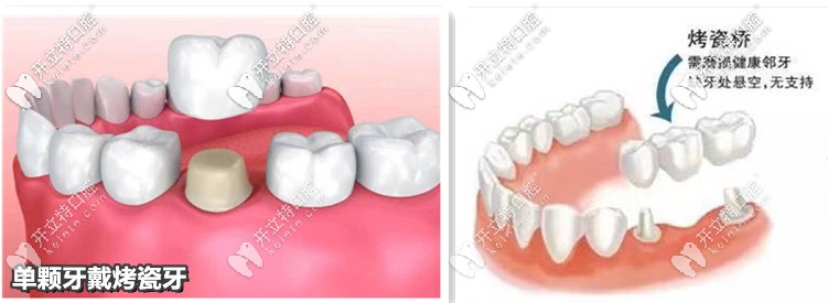 單顆、3連冠烤瓷牙—示意圖