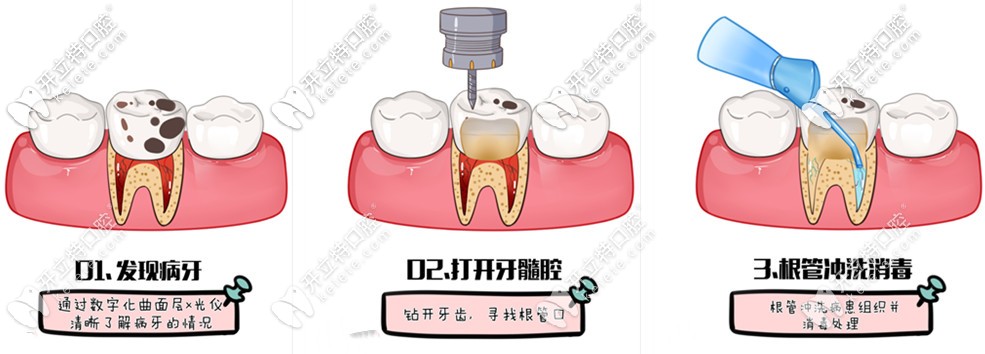 根管治療過程
