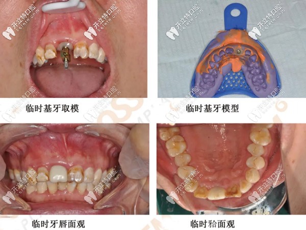 取模安裝臨時(shí)牙冠