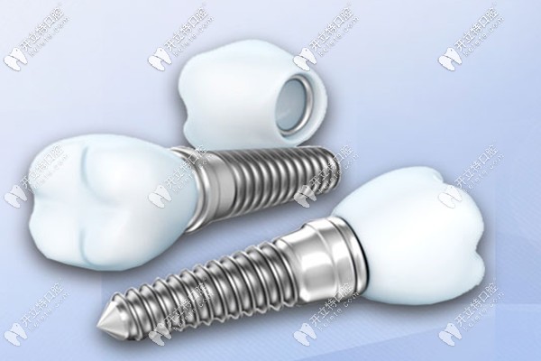 柳州做微創(chuàng)種植牙的價(jià)格