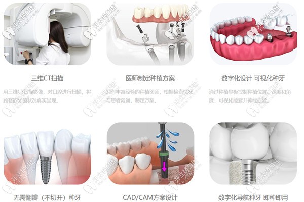 微創(chuàng)種植牙的過(guò)程