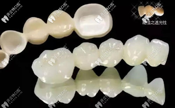 深圳格倫菲爾威蘭德全瓷牙的價(jià)格