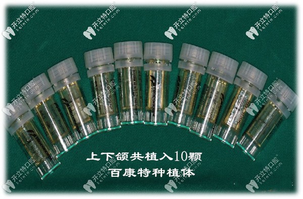 全口植入10顆國產(chǎn)百康特種植體
