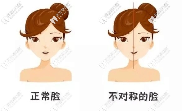 單側(cè)咀嚼的危害不僅導(dǎo)致下頜骨不對(duì)稱,且歪臉不一定能恢復(fù)
