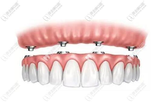 半口半固定種植體