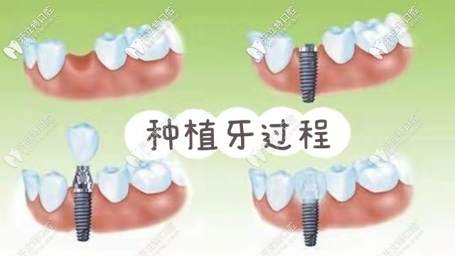 韓國紐百特和登騰的使用壽命