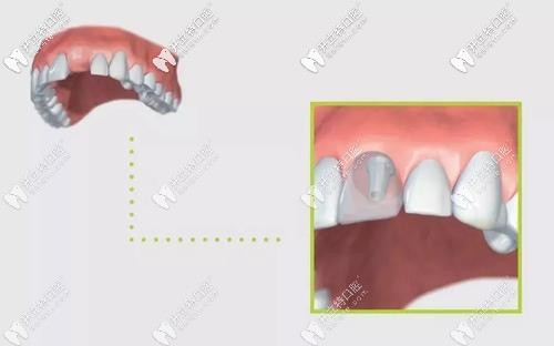 可以避免牙周被破壞的種植牙新技術(shù)“盾構(gòu)術(shù)”了解一下？