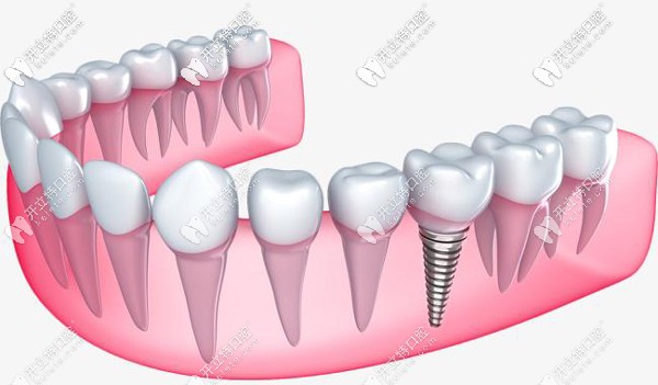 韓國紐百特neo種植體的優(yōu)點