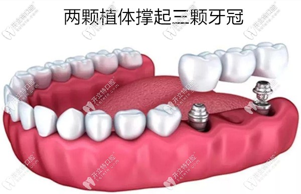 兩顆植體撐起三顆牙冠