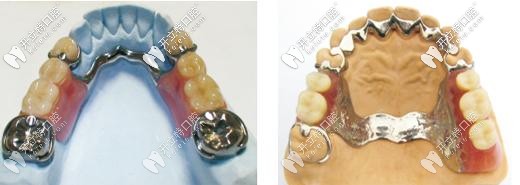 活動(dòng)義齒牙托一般什么材質(zhì)好?談?wù)劶冣伜外伜辖鹧劳袇^(qū)別