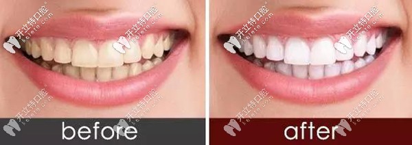 琥珀瓷牙貼面前后對(duì)比