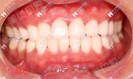 西安美奧口腔不良修復(fù)體拆除后瓷貼面修復(fù)案例