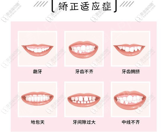 哪些牙齒要做牙齒矯正呢？請(qǐng)對(duì)號(hào)入座！