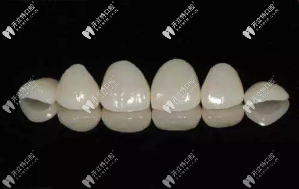 琥珀瓷牙貼面價(jià)格