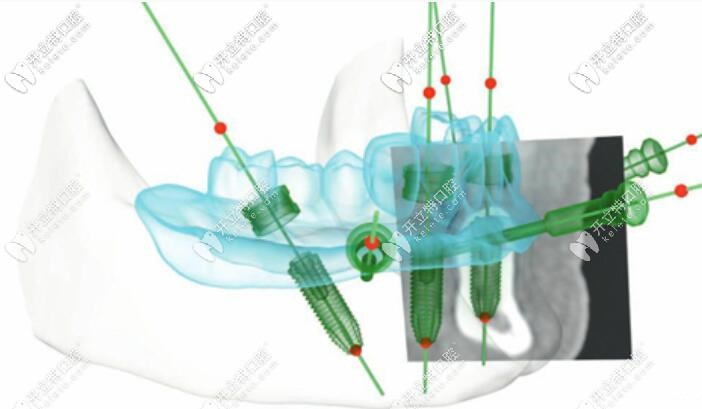 當天種當天用技術