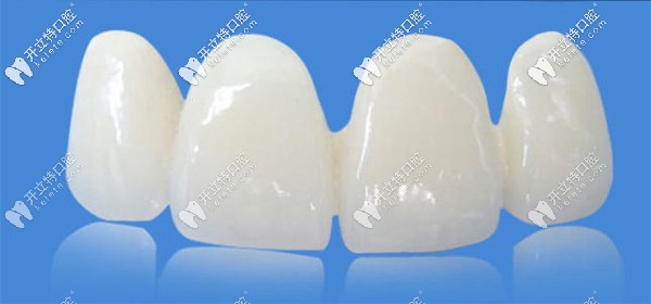 國(guó)產(chǎn)美晶瓷PK愛爾創(chuàng)全瓷牙哪個(gè)好？來看價(jià)格及優(yōu)缺點(diǎn)~