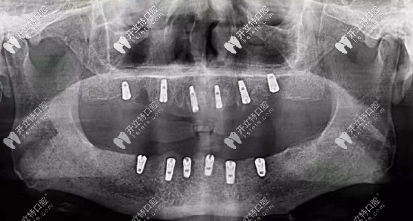 半口種植6顆牙根的全景片示意圖