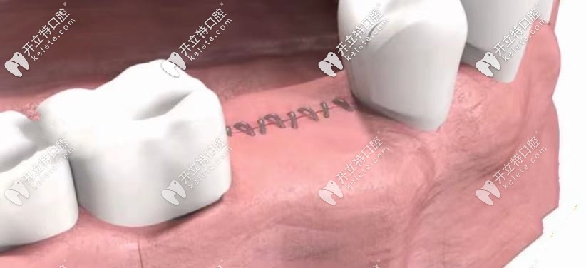 在縫合傷口后，經(jīng)過時(shí)間愈合：7天左右即可拆線