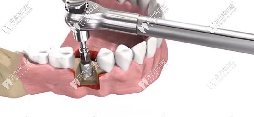 將種植體擰入牙槽骨螺紋孔中，擰緊螺釘固定