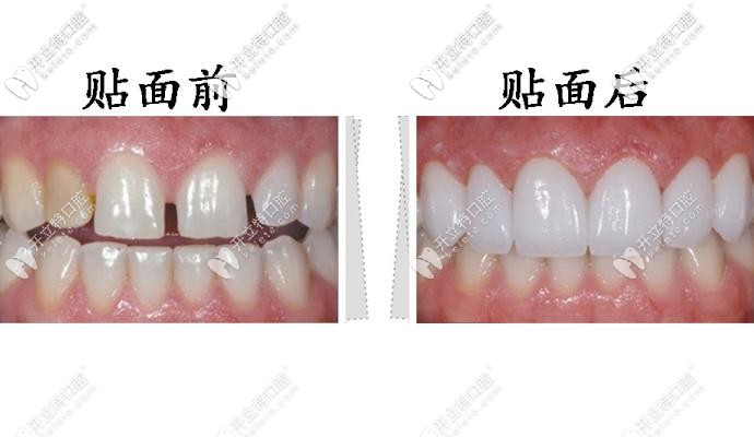 牙齒貼面前后對比圖